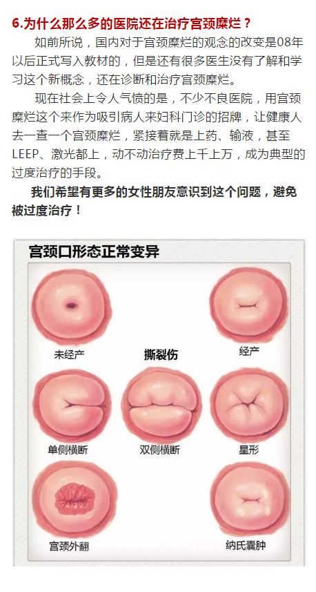 糜烂宫颈和正常宫颈图图片